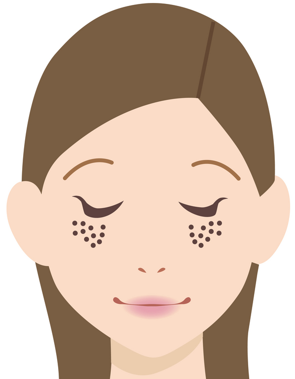 奈良のソバカス治療にライムライト　美容外科皮膚科ピュアメディカルクリニック